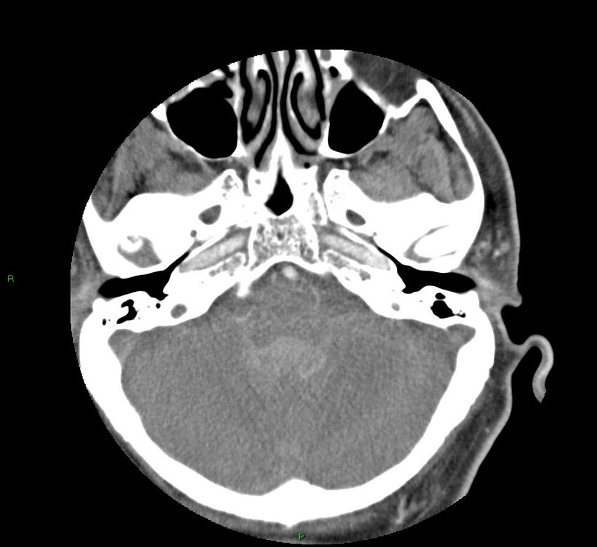 Basal ganglia hemorrhage (Radiopaedia 58763-65985 D 42).jpg