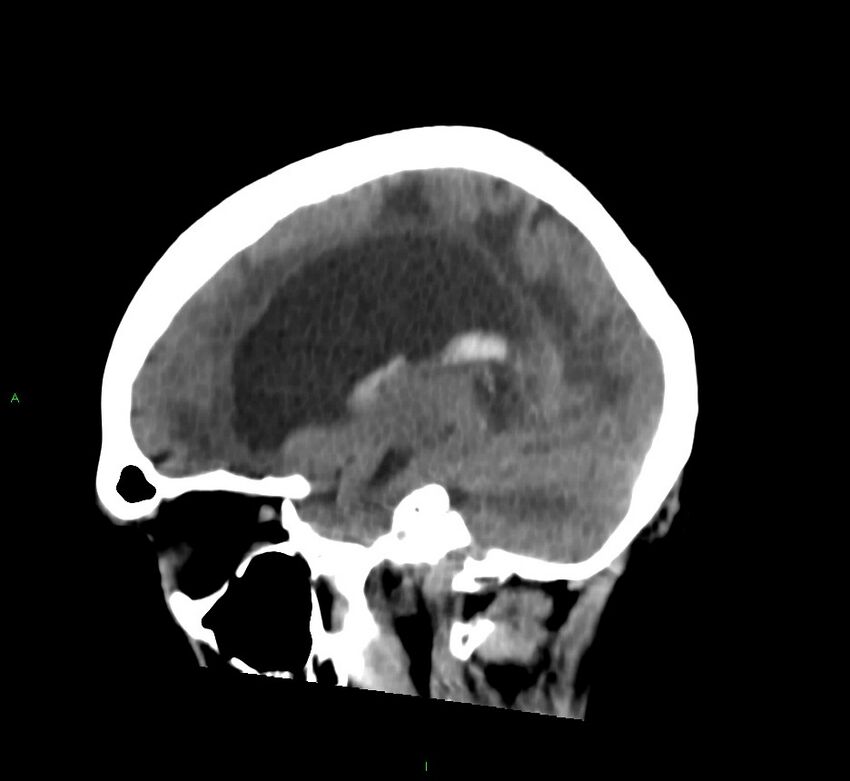 Basal ganglia hemorrhage (Radiopaedia 58766-65988 C 18).jpg