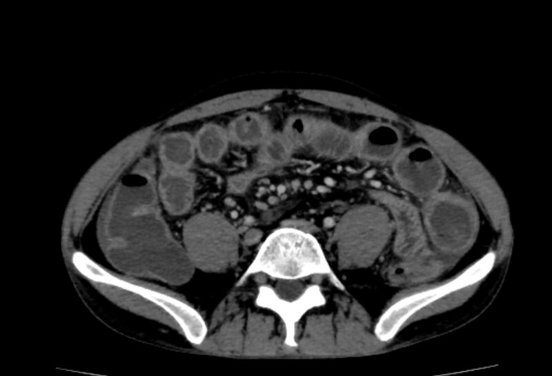 File:Behçet's disease- abdominal vasculitis (Radiopaedia 55955-62570 A 57).jpg