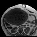 Benign seromucinous cystadenoma of the ovary (Radiopaedia 71065-81300 Axial T1 30).jpg