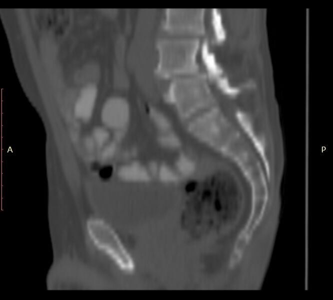 File:Bertolotti syndrome (Radiopaedia 58974-66235 Sagittal bone window 22).jpg