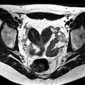 Bicornuate uterus (Radiopaedia 11104-11492 Axial T2 22).jpg