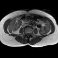 Bicornuate uterus (Radiopaedia 61974-70046 Axial T1 7).jpg