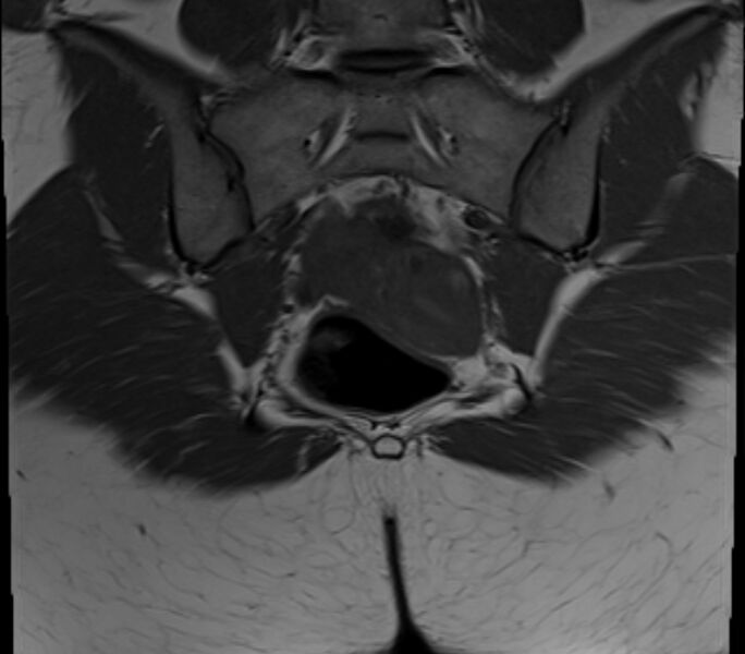 File:Bicornuate uterus (Radiopaedia 71214-81511 Coronal T1 6).jpg
