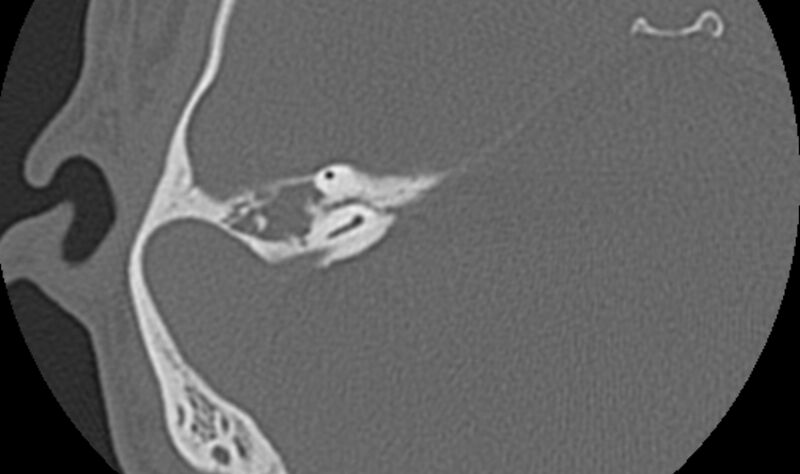 File:Bilateral cholesteatoma (Radiopaedia 54898-61172 Axial bone window 36).jpg