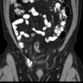 Bilateral direct inguinal herniae (Radiopaedia 17016-16719 A 9).jpg