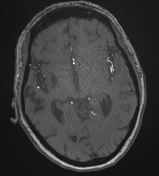 File:Bilateral fetal posterior communicating arteries (Radiopaedia 41286-44102 Axial MRA 102).png