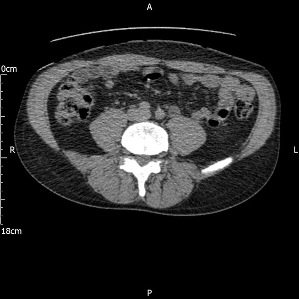 File:Bilateral medullary nephrocalcinosis with ureteric calculi (Radiopaedia 71269-81569 Axial non-contrast 79).jpg