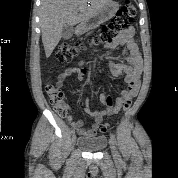 File:Bilateral medullary nephrocalcinosis with ureteric calculi (Radiopaedia 71269-81569 Coronal non-contrast 23).jpg