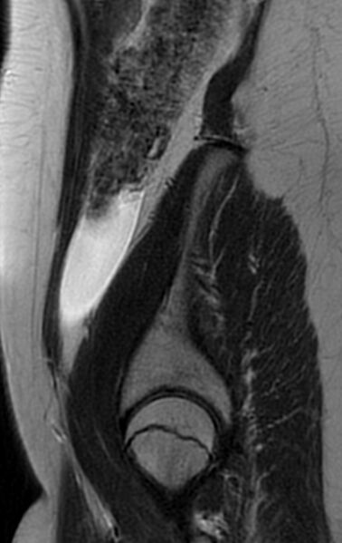 File:Bilateral ovarian fibrothecomas - adolescent (Radiopaedia 86604-102707 Sagittal T2 3).jpg