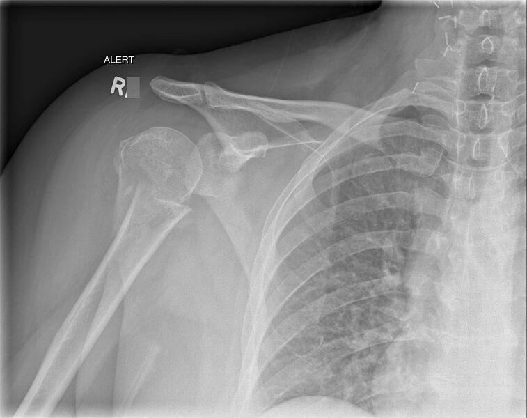 File:Bilateral shoulder injuries on chest x-ray (Radiopaedia 50809-56297 Frontal 1).jpg