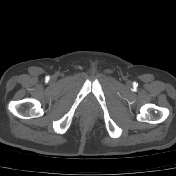 File:Bilateral superficial femoral arterial occlusion (Radiopaedia 25682-25857 A 29).jpg