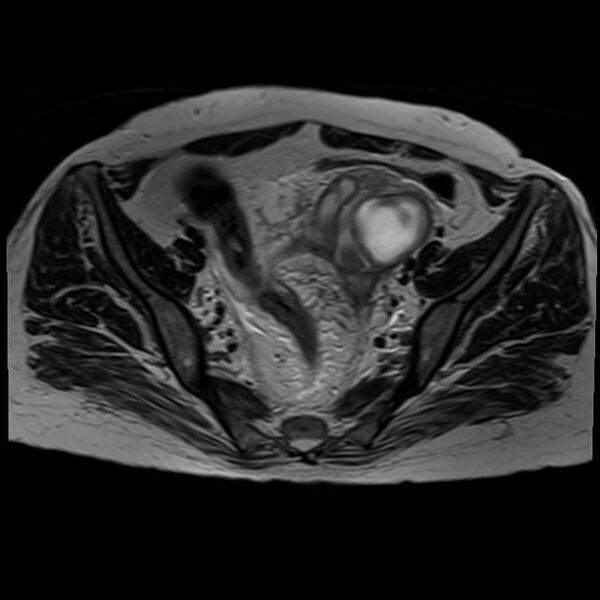File:Bilateral tubo-ovarian abscesses (Radiopaedia 58635-65829 Axial T2 17).jpg