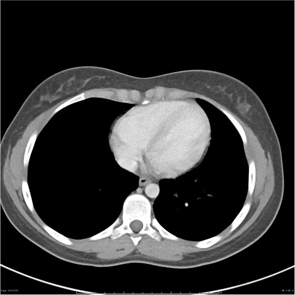 File:Bilateral ureteritis and cystitis (Radiopaedia 25340-25594 A 1).jpg
