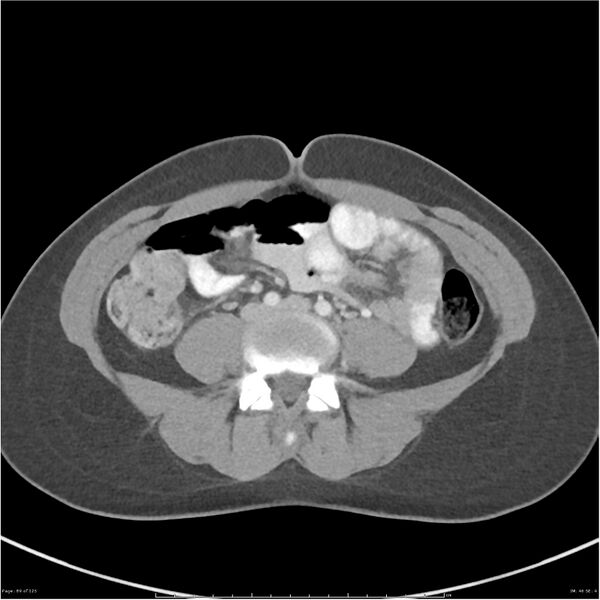 File:Bilateral ureteritis and cystitis (Radiopaedia 25340-25594 A 46).jpg