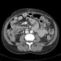 Biliary necrosis - liver transplant (Radiopaedia 21876-21846 B 41).jpg