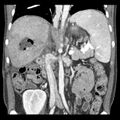 Biliary necrosis - liver transplant (Radiopaedia 21876-21846 C 28).jpg
