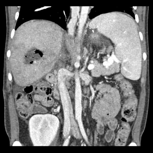 File:Biliary necrosis - liver transplant (Radiopaedia 21876-21846 C 28).jpg