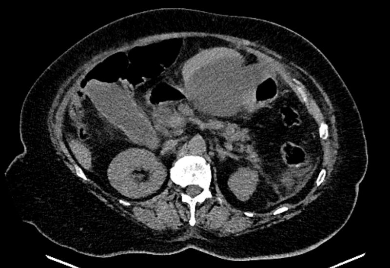 File:Biliary pancreatitis (Radiopaedia 72289-82823 Axial non-contrast 100).jpg
