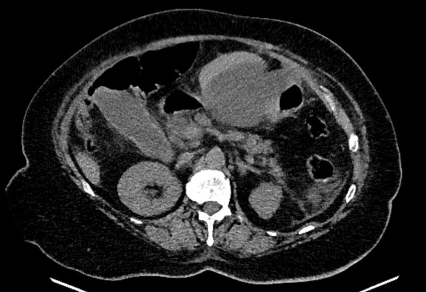 Biliary pancreatitis (Radiopaedia 72289-82823 Axial non-contrast 100).jpg