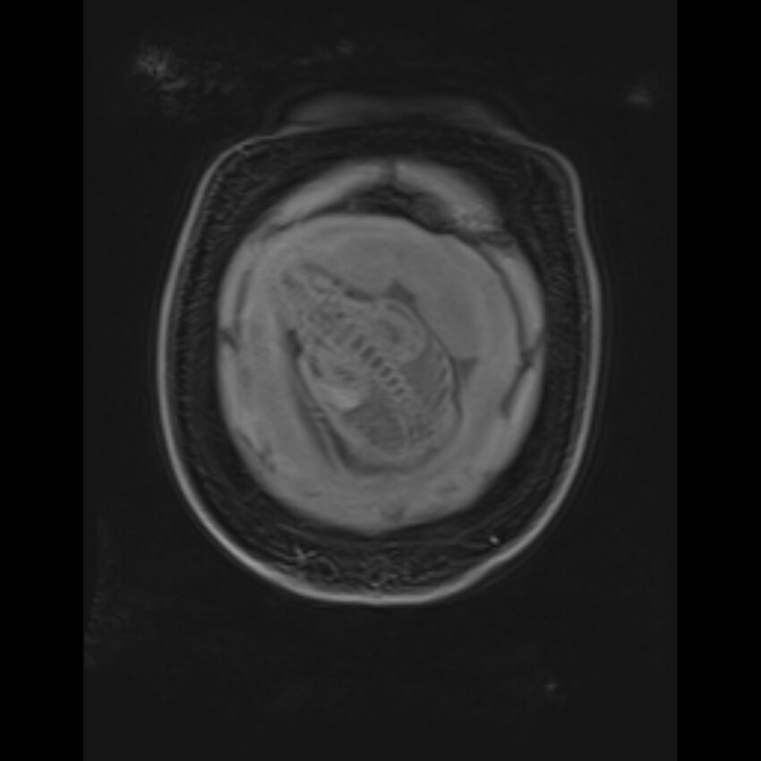 Bilobed placenta accreta (Radiopaedia 69648-79591 Coronal T1 vibe 22).jpg
