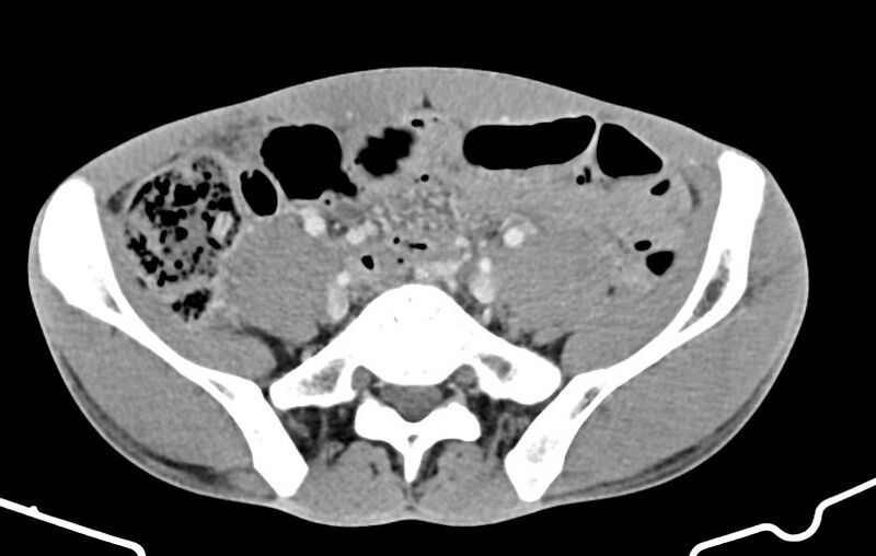 File:Blunt injury to the small bowel (Radiopaedia 74953-85987 A 137).jpg