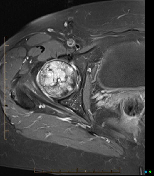File:Bone metastasis - breast cancer (Radiopaedia 16667-16374 Axial T1 C+ fat sat 11).jpg