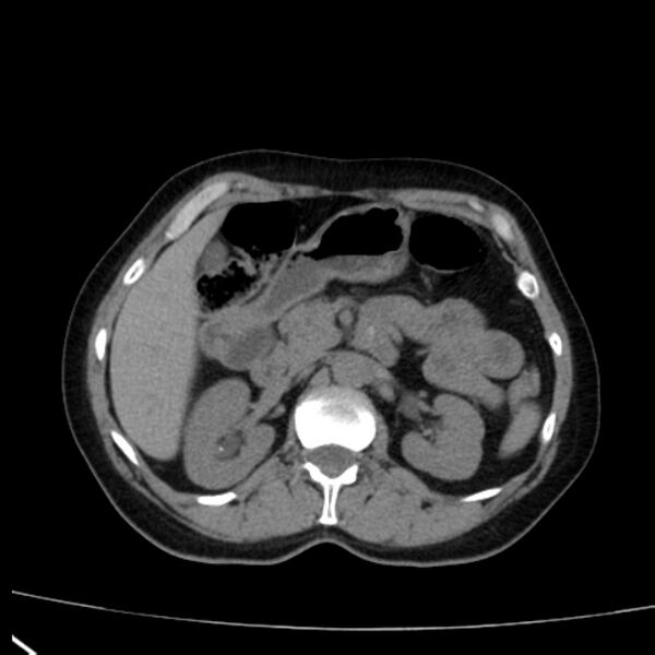 File:Bosniak renal cyst - type I (Radiopaedia 27479-27675 Axial non-contrast 31).jpg