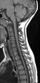 Brachial plexus birth palsy (Radiopaedia 68118-77604 Sagittal T1 7).jpg
