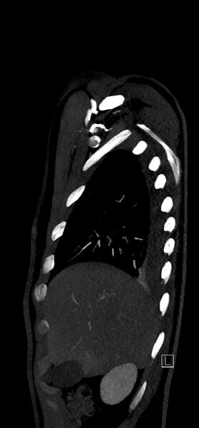 File:Brachiocephalic trunk pseudoaneurysm (Radiopaedia 70978-81191 C 18).jpg