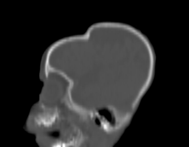 File:Brachycephaly (bi-coronal and bi-lambdoid synostosis) (Radiopaedia 55048-61413 Sagittal bone window 7).jpg