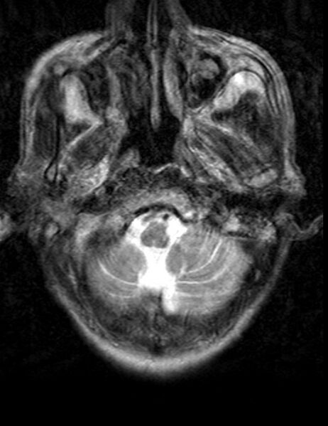 File:Brain abscess with dual rim sign (Radiopaedia 87566-103938 Axial T2 1).jpg