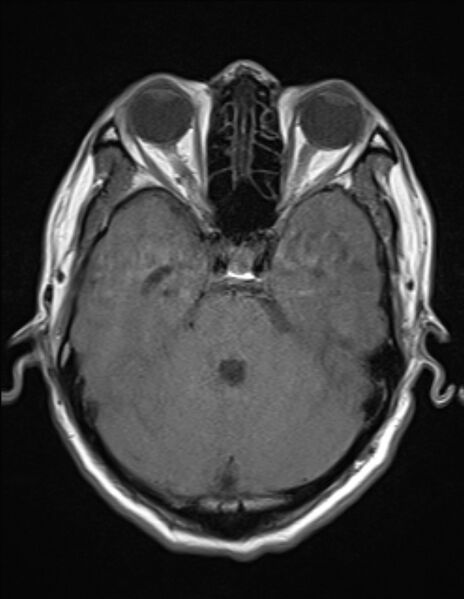 File:Brain abscess with ventriculitis (Radiopaedia 85703-101495 Axial T1 8).jpg