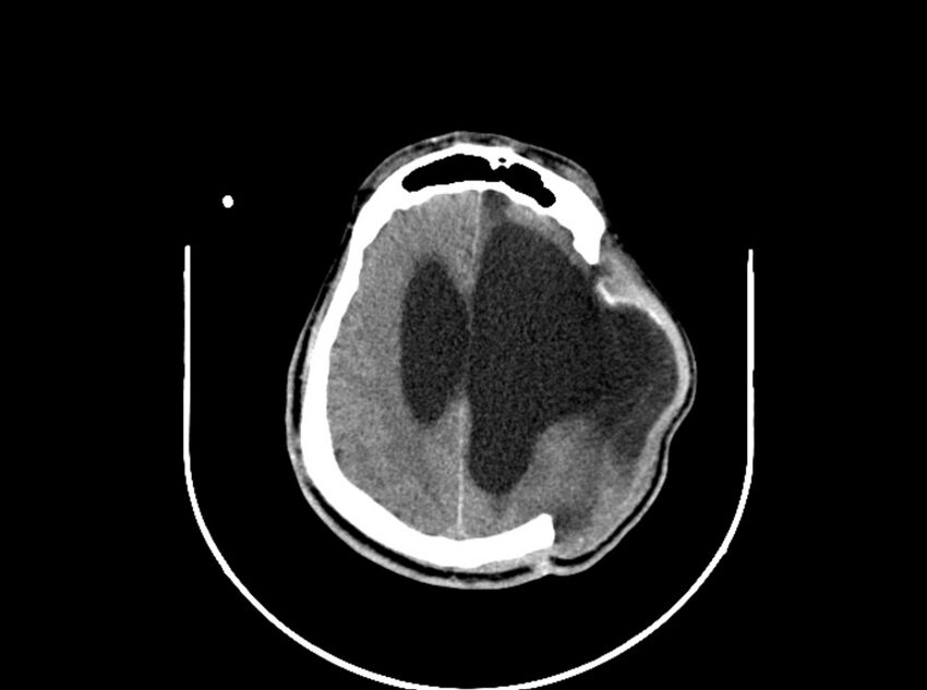 Brain injury by firearm projectile (Radiopaedia 82068-96088 A 152).jpg