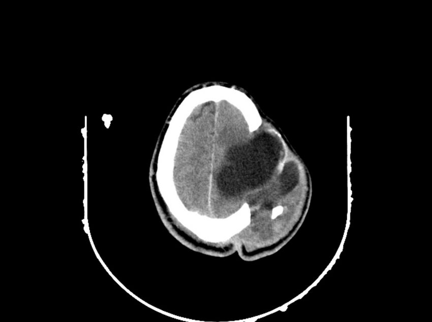 Brain injury by firearm projectile (Radiopaedia 82068-96088 A 177).jpg