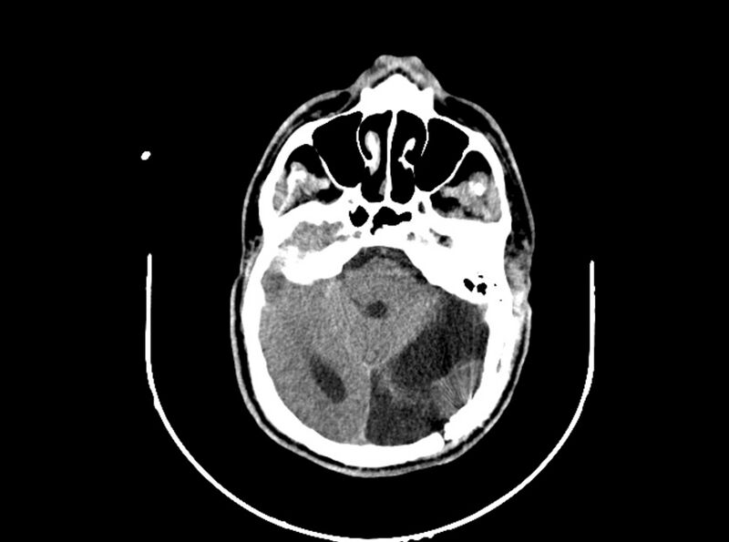 File:Brain injury by firearm projectile (Radiopaedia 82068-96088 A 97).jpg