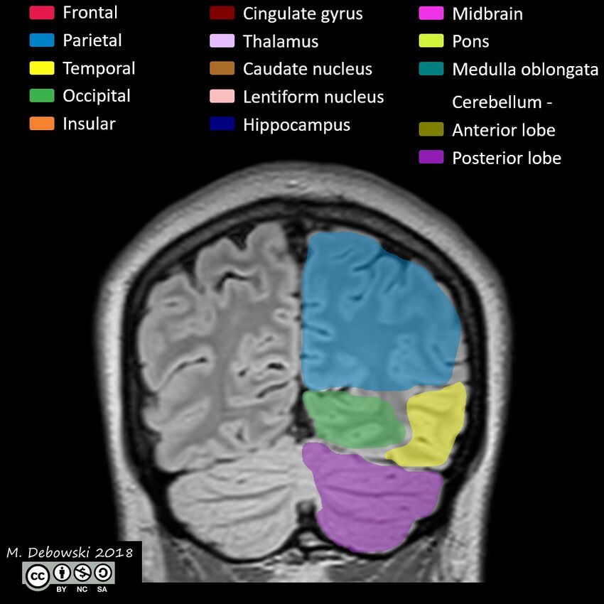 Brain lobes - annotated MRI (Radiopaedia 61691-69700 Coronal 58).JPG