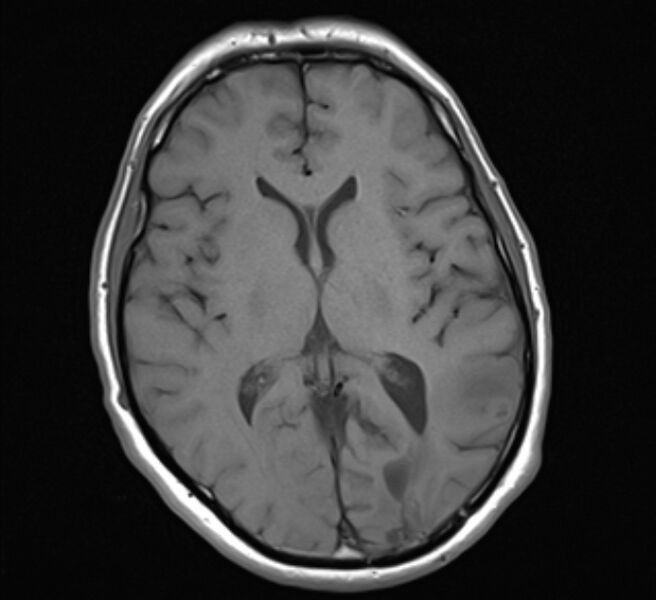 File:Brain metastases - lung cancer primary (Radiopaedia 75060-86115 Axial T1 14).jpg