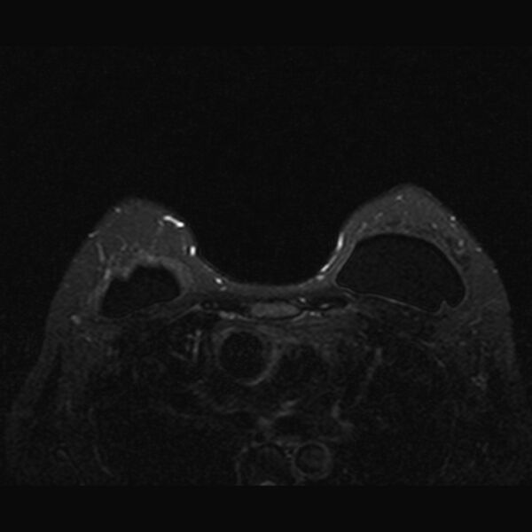 File:Breast implants - MRI (Radiopaedia 26864-27035 T2 SPAIR 37).jpg