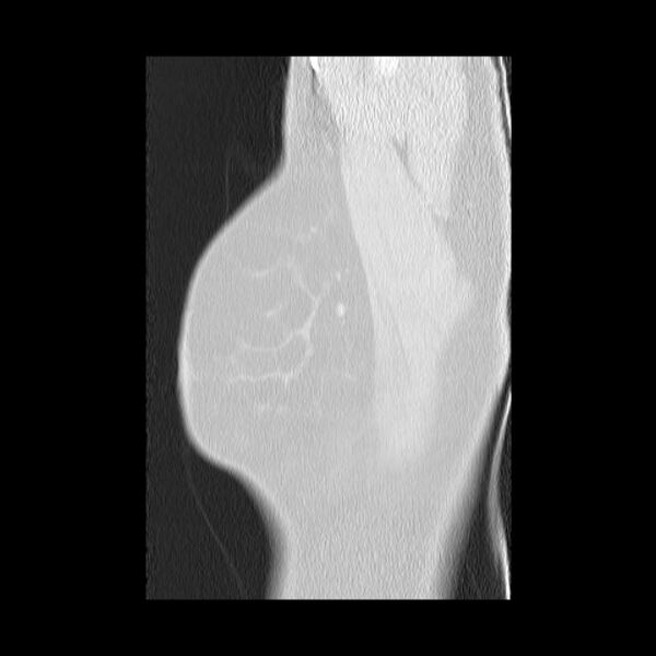 File:Bronchial atresia (Radiopaedia 22965-22992 Sagittal lung window 1).jpg
