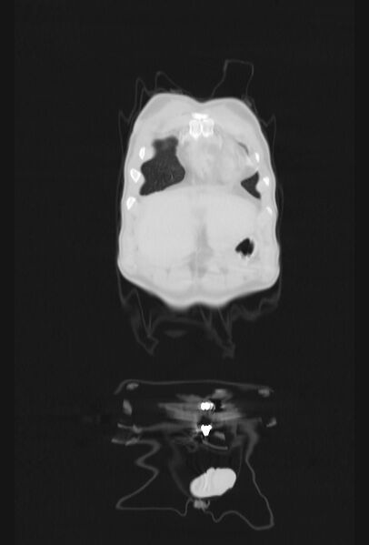File:Bronchial carcinoid tumor (Radiopaedia 57187-64090 Coronal lung window 3).jpg