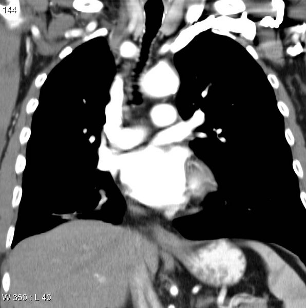 File:Bronchial carcinoid tumor with right lower lobe collapse (Radiopaedia 29060-29422 C 13).jpg