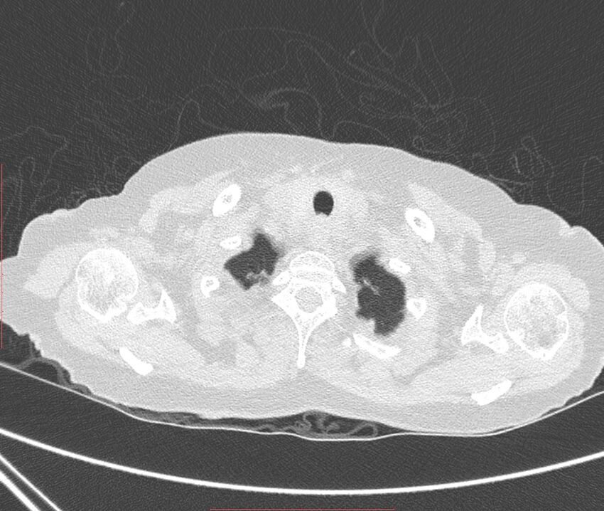Bronchiectasis (Radiopaedia 72693-83293 Axial lung window 2).jpg
