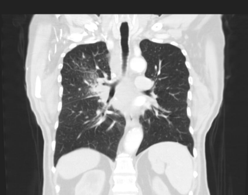 Bronchogenic carcinoma with lymphangitic spread (Radiopaedia 29002-29357 Coronal lung window 41).jpg