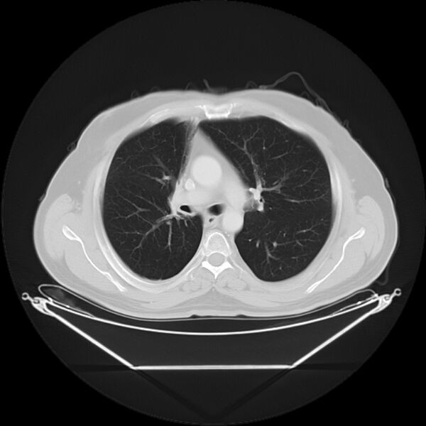 File:Bronchogenic carcinoma with upper lobe collapse (Radiopaedia 29297-29726 Axial lung window 14).jpg
