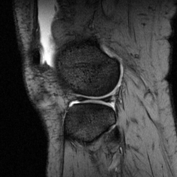 File:Bucket handle tear - medial meniscus (Radiopaedia 79028-91942 D 5).jpg