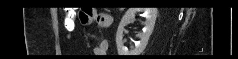 File:Buried bumper syndrome - gastrostomy tube (Radiopaedia 63843-72575 Sagittal Inject 33).jpg