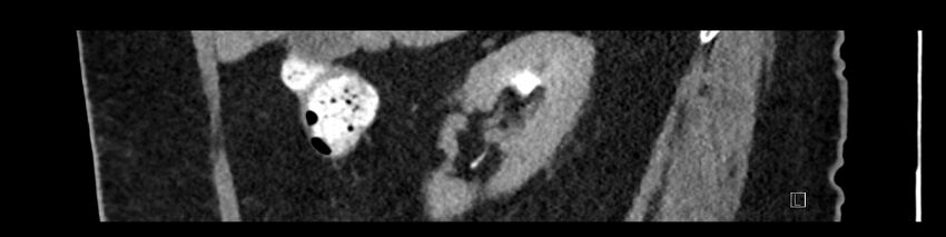 Buried bumper syndrome - gastrostomy tube (Radiopaedia 63843-72575 Sagittal Inject 85).jpg