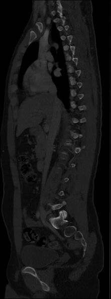 File:Burst fracture (Radiopaedia 83168-97542 Sagittal bone window 60).jpg