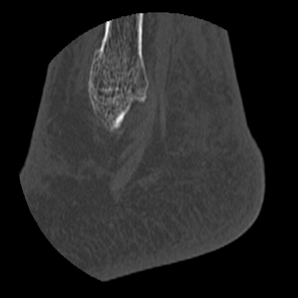 File:Calcaneal tuberosity avulsion fracture (Radiopaedia 22649-22668 D 2).jpg